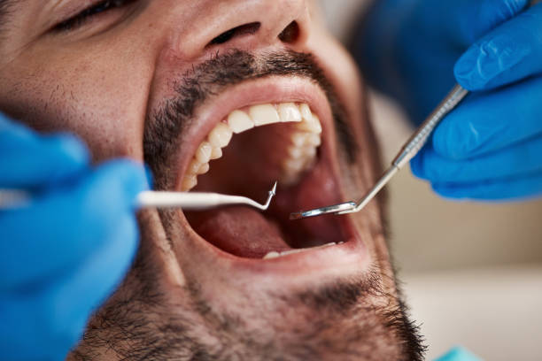 Best Emergency Wisdom Teeth Removal in Wentworth, NC